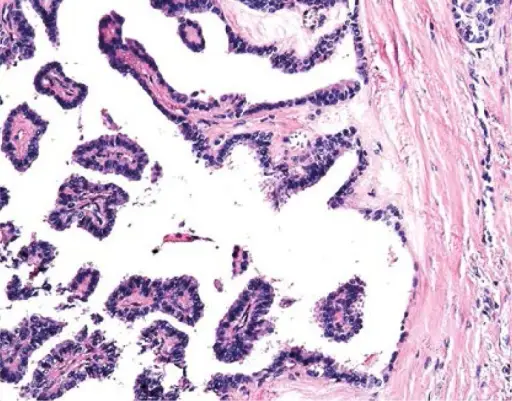 Thyroglossal Duct Cysts