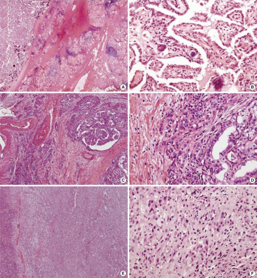 Thyroid Carcinomas