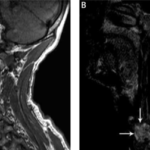 Thyroid Congenital Nodules