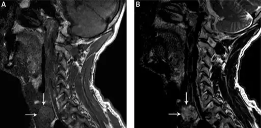 Thyroid Congenital Nodules