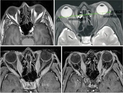 Thyroid Dysfunction Hormonal Neuropathy