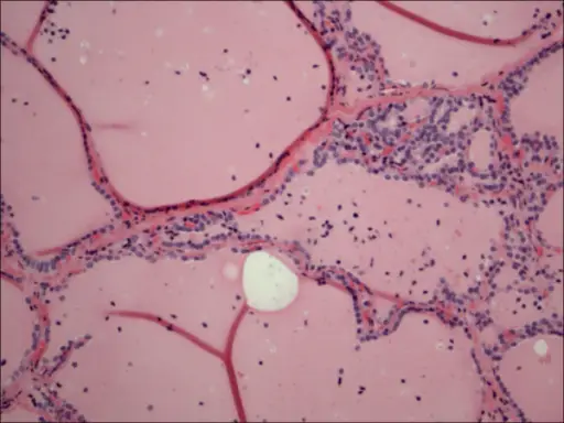 Thyrotoxicosis