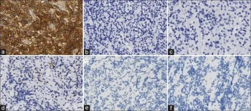 Thyrotroph Adenomas