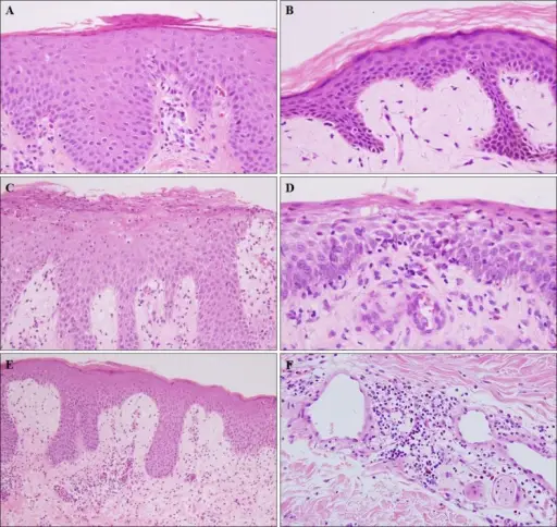 Tinea