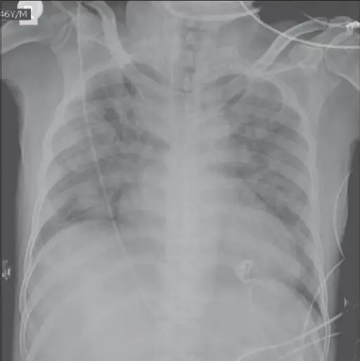 Transfusion Associated Circulatory Overload