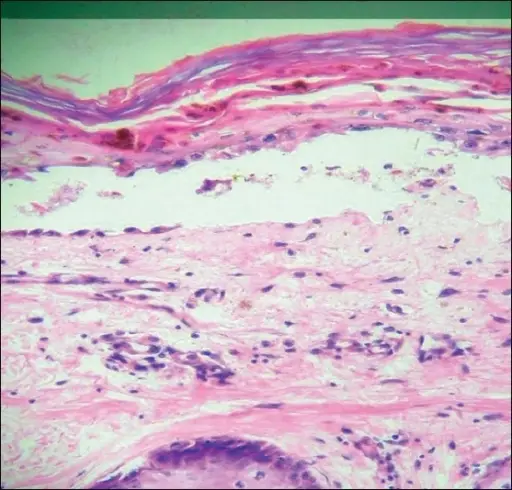 Transfusion Associated Graft Versus Host Disease