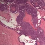 Transitional Cell Tumors of the Ovary