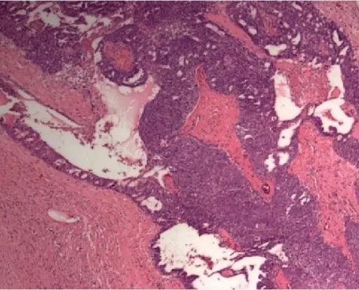 Transitional Cell Tumors of the Ovary