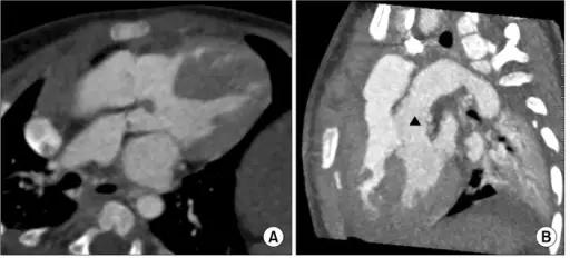 Transposition of the Great Arteries