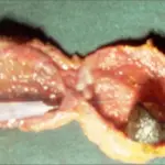 Transverse Septum of the Gallbladder