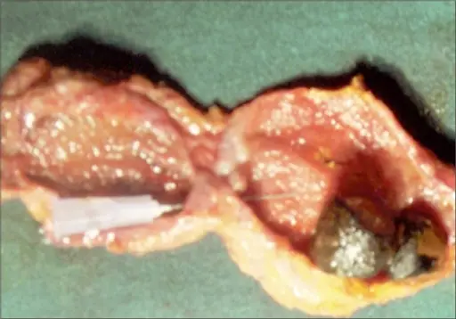 Transverse Septum of the Gallbladder