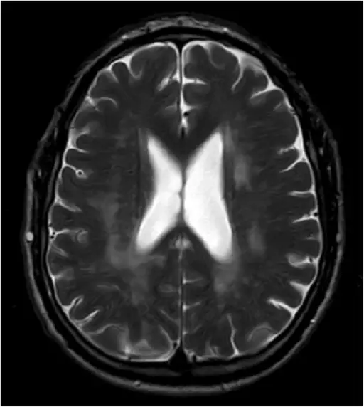 Trauma of the Central Nervous System