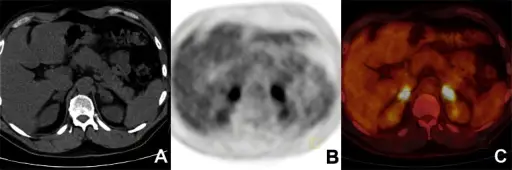 Tuberculosis Adrenalitis