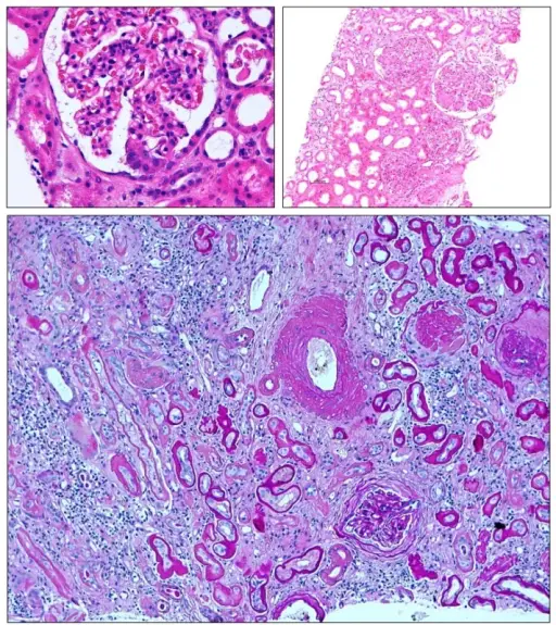 Tubular and Interstitial Diseases