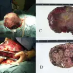 Tumors of the Peritoneal Cavity