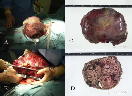 Tumors of the Peritoneal Cavity