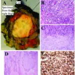 Tumors of Bone or Cartilage of Unknown Origin