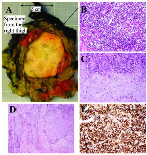 Tumors of Bone or Cartilage of Unknown Origin