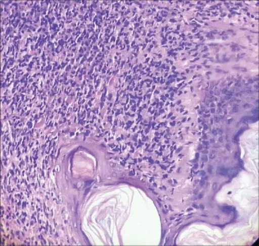 Tumors of Cellular Migrants to the Skin