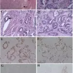 Tumors of Endometrial Stroma