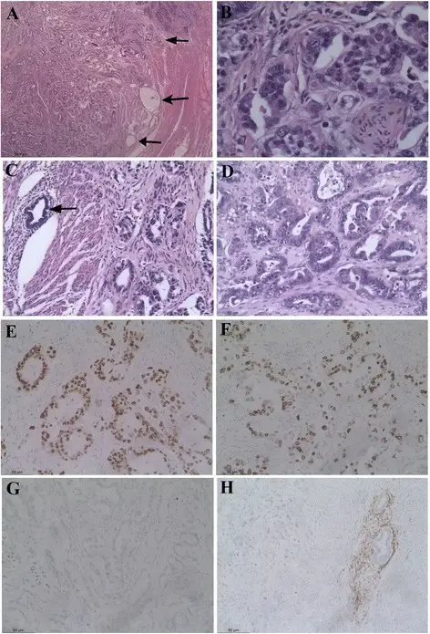 Tumors of Endometrial Stroma