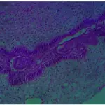 Tumors of Odontogenic Ectomesenchyme