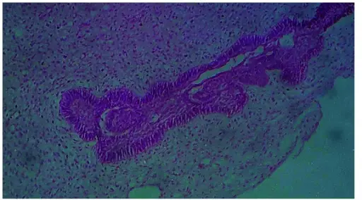 Tumors of Odontogenic Ectomesenchyme