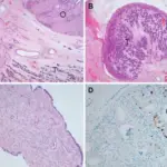 Tumors of Sex Cord-Gonadal Stroma