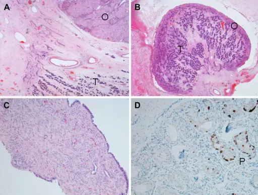 Tumors of Sex Cord-Gonadal Stroma