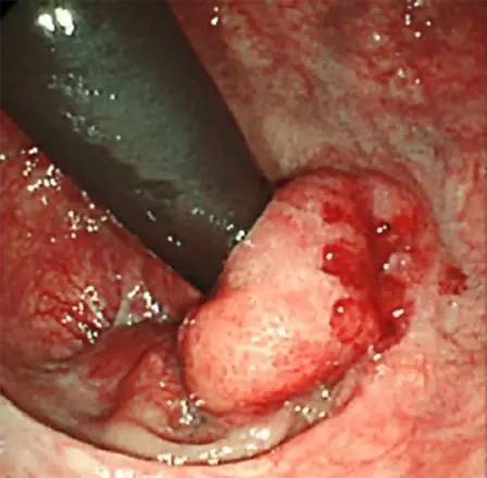 Tumors of the Anal Canal