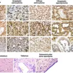 Tumors of the Central Nervous System