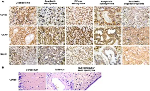 Tumors of the Central Nervous System