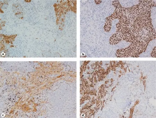 Tumors of the Dermis