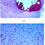 Tumors of the Heart