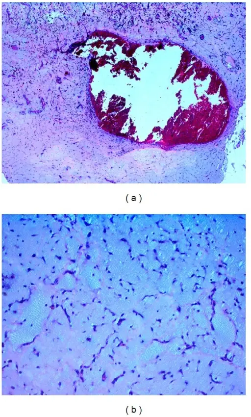 Tumors of the Heart