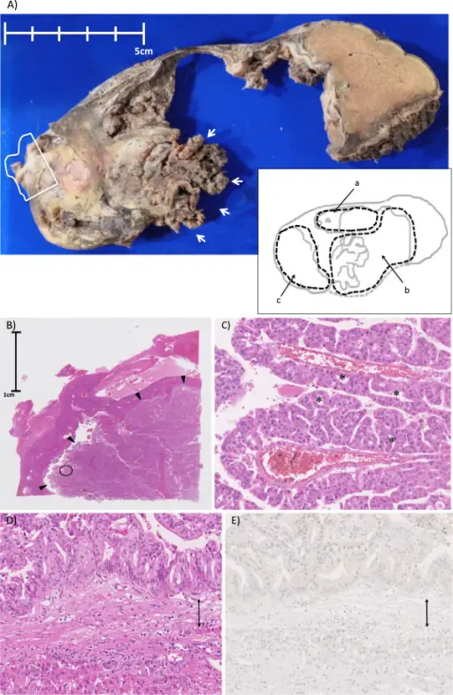 Tumors of the Liver