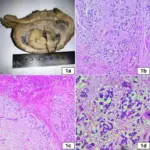 Tumors of the Myometrium