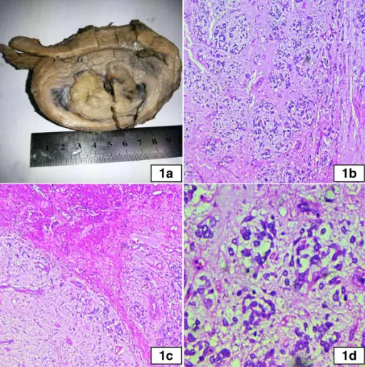 Tumors of the Myometrium