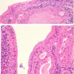 Tumors of the Nasopharynx