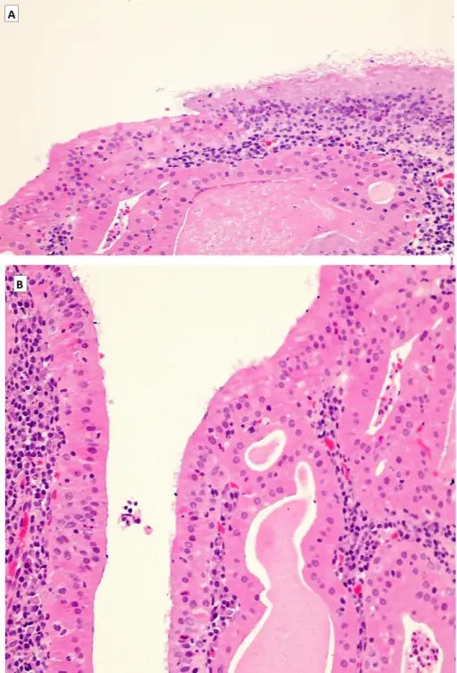 Tumors of the Nasopharynx