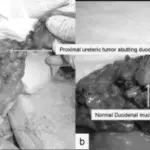 Tumors of the Ureter