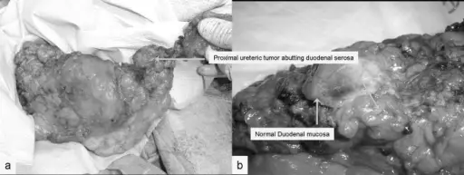 Tumors of the Ureter