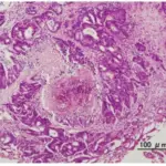 Tumors of the Urethra