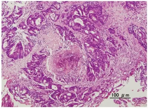 Tumors of the Urethra