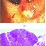 Turcot Syndrome