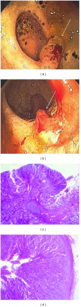 Turcot Syndrome