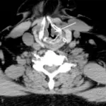 UPPER AIRWAY PATHOLOGY