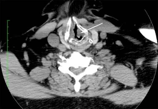 UPPER AIRWAY PATHOLOGY