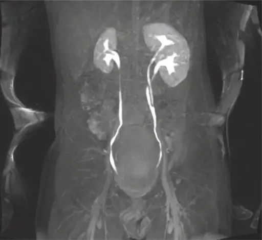 URINARY TRACT PATHOLOGY