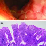 Ulcerative Colitis